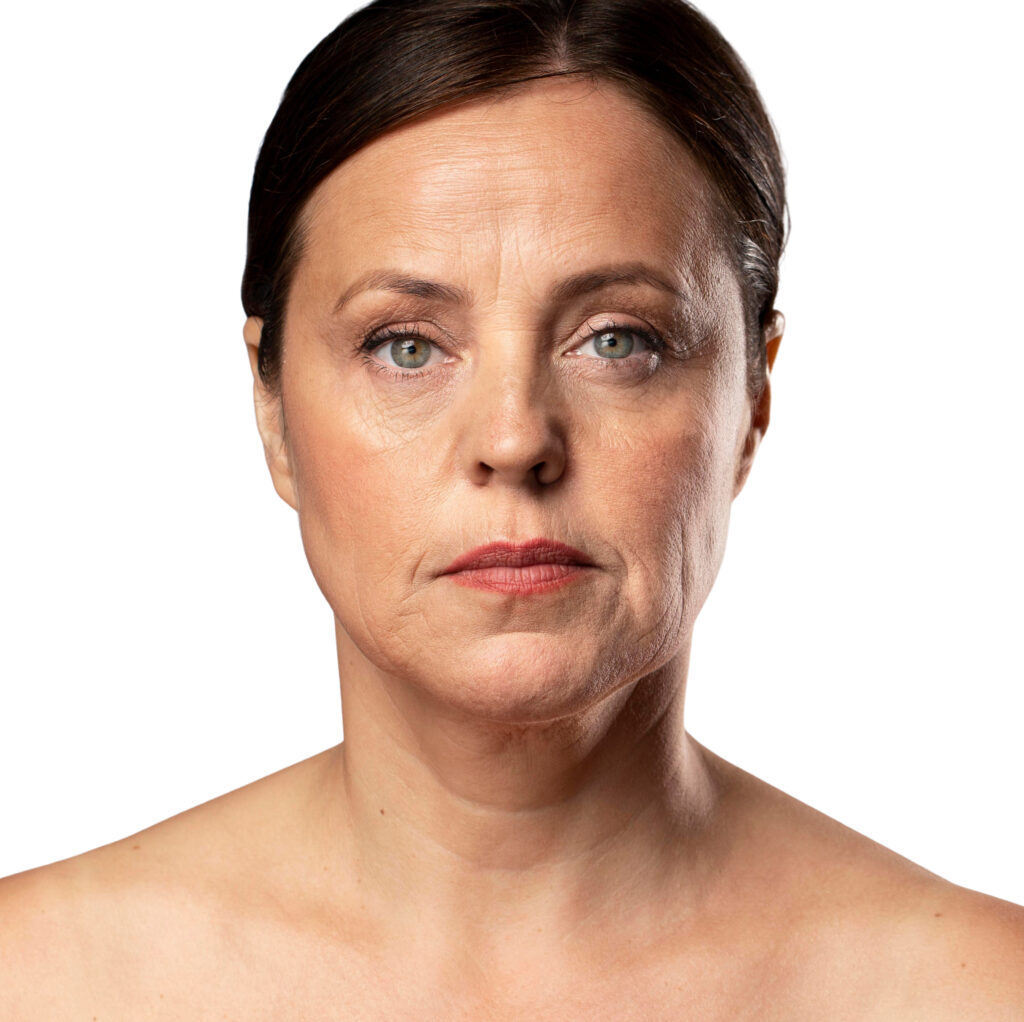 How to Reduce Neck Lines and Wrinkles Naturally